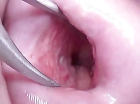 Japanese Wife Open Cervix Wide to watch inside Uterus